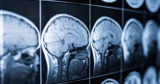 Brain Injury Attorney Bronx Jesse Minc Personal Injury Law